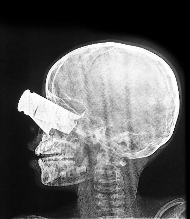 Tchad : Un enfant gravement blessé par un drone dans l’ouest du Soudan